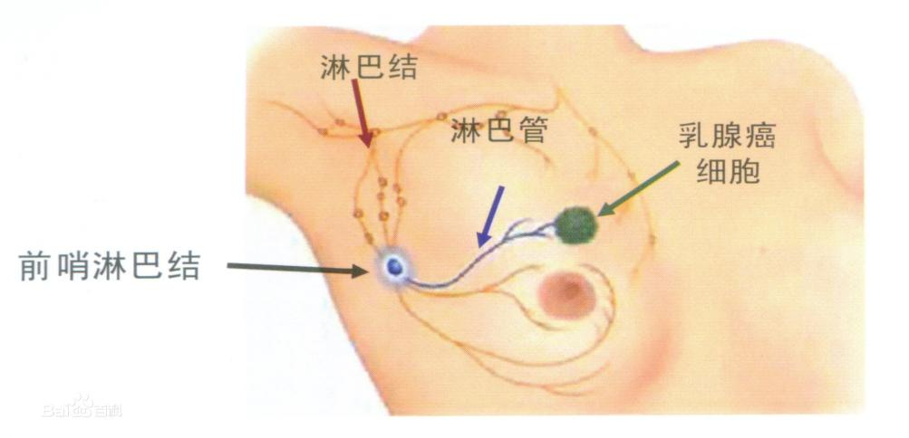 张凌捷医生：乳腺癌前哨淋巴结的那些事