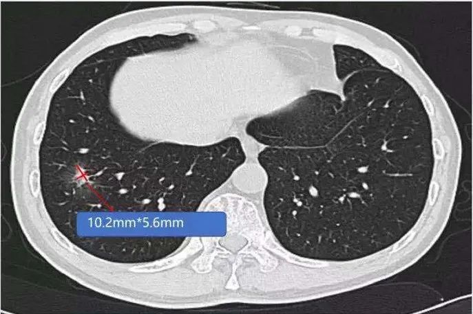 PET-CT在乳腺癌诊断中的应用