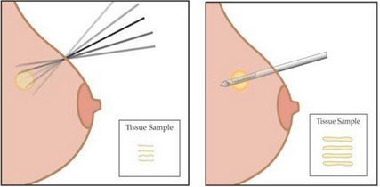 沈教授谈乳腺癌：穿刺活检会引起肿瘤扩散吗？麦默通是什么？