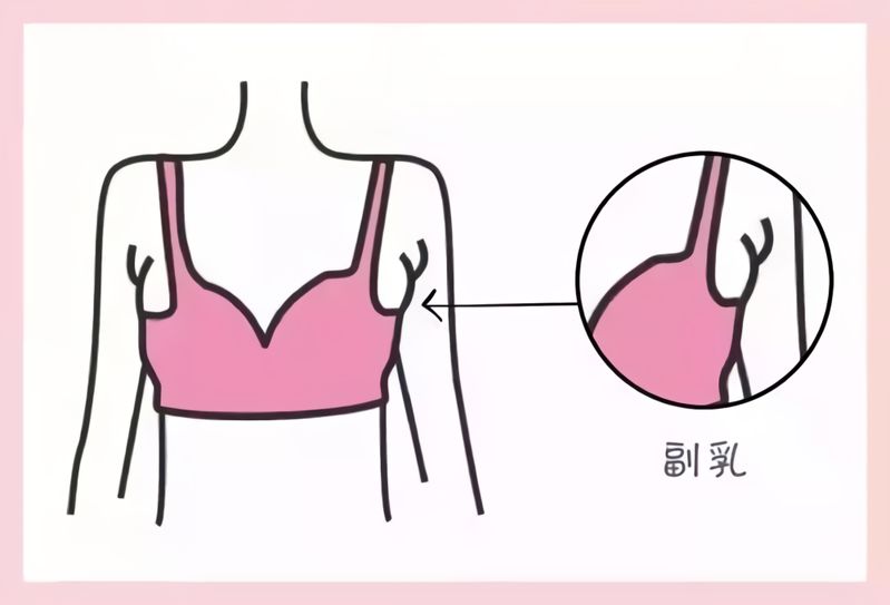 医生，副乳腺会不会得乳腺癌，需要提前切掉吗？