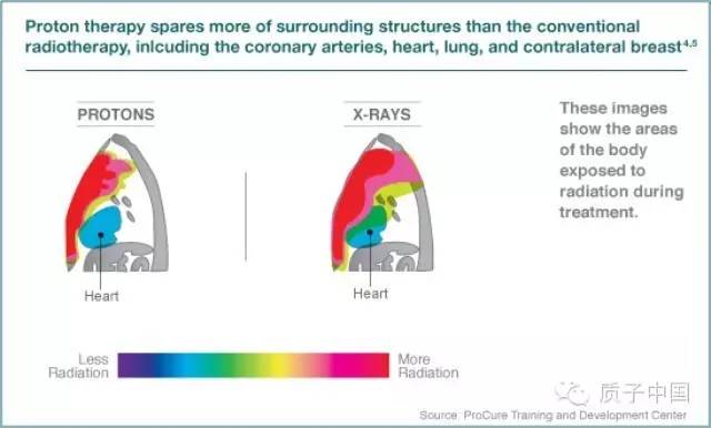 研究结果表明质子治疗乳腺癌生存率和美容效果俱佳