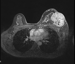 【乳腺癌疑难病例艾月谈】一例初发脑转移乳腺癌患者的治疗经验探