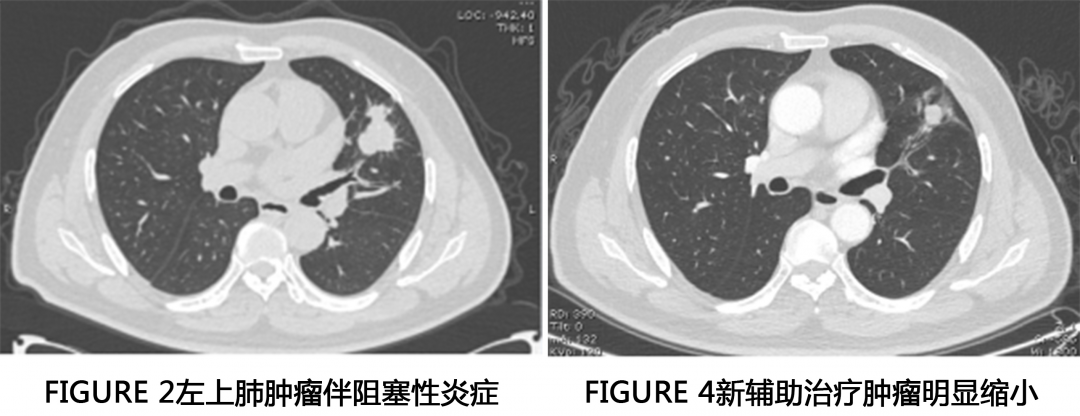 局部晚期肺癌就是“宣判书”？ “新辅助治疗”让不可能成为可能