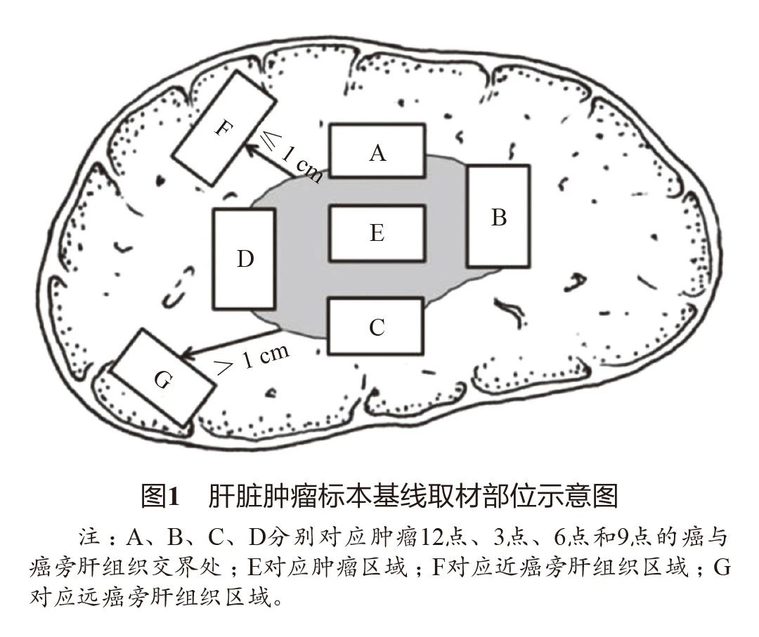 全文收藏丨原发性肝癌诊疗指南(2022年版)