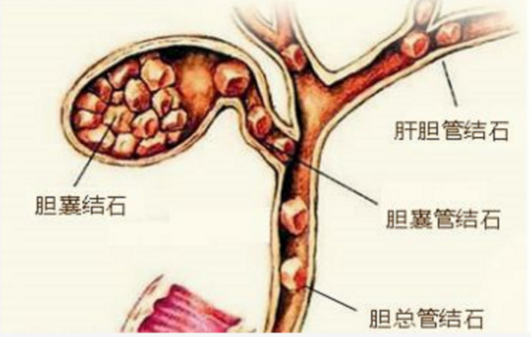  胆道肿瘤发病的高危因素