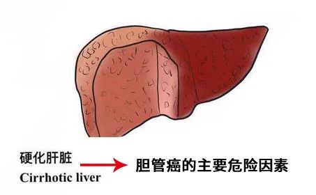 胆管癌死亡率攀升，这些高危因素你一定要知道