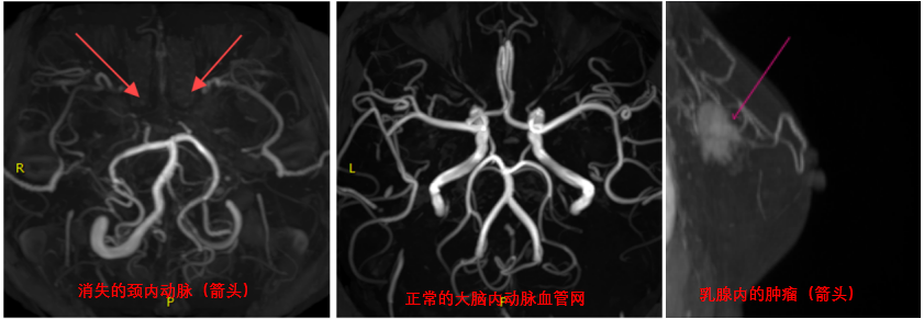 烟雾病下战乳癌——南大一附院乳腺专病中心成功为一烟雾病患者实