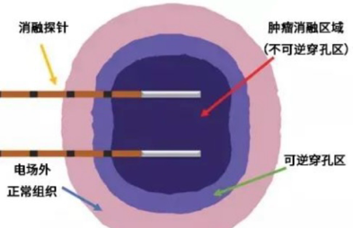 中国医科大学附属第一医院泌尿外科围绕前列腺癌诊治开展多项国内