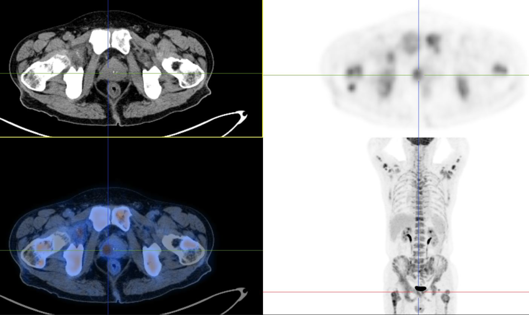 前列腺癌精准诊疗再添新手段