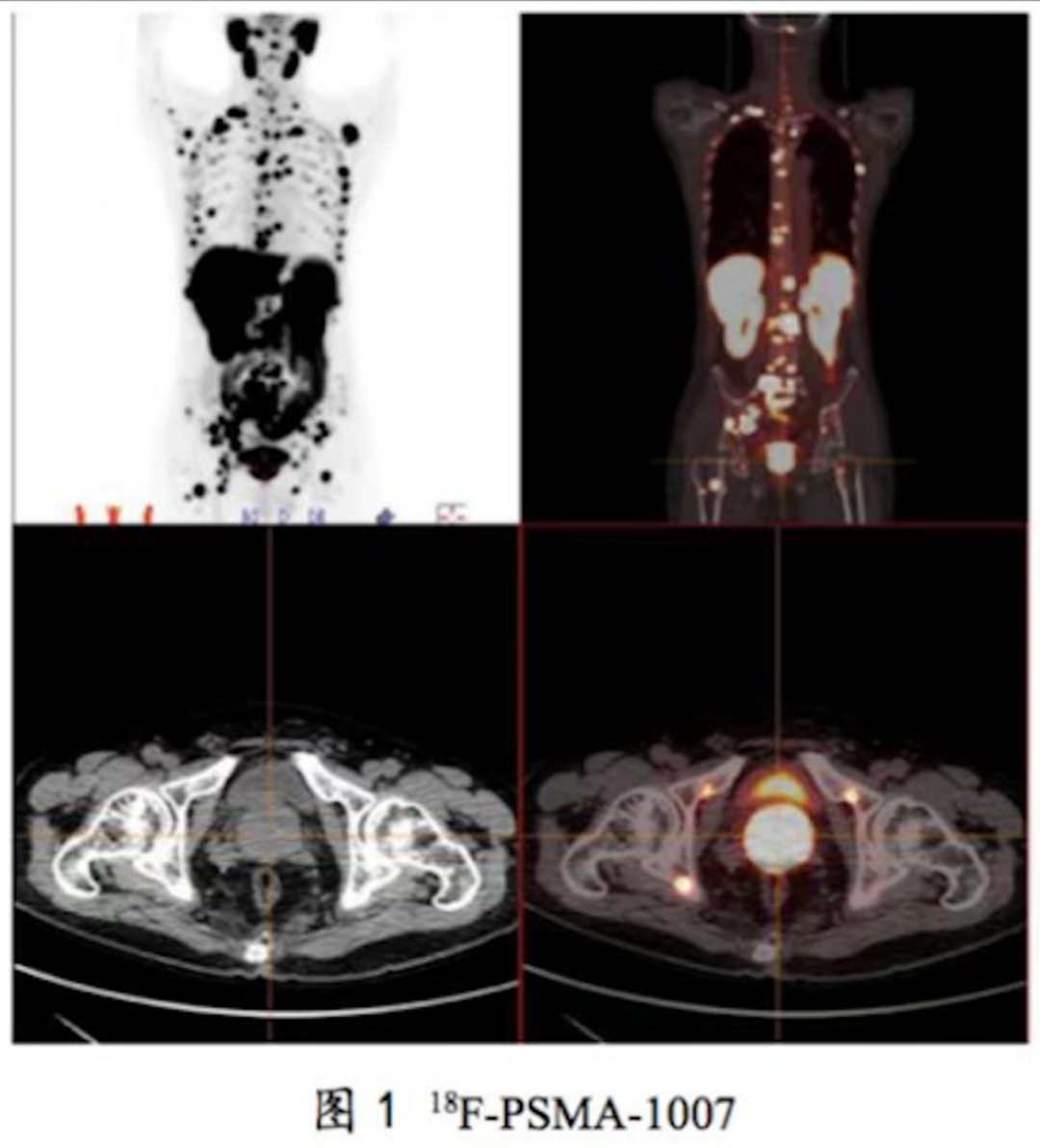 PSMA PET对前列腺癌的精准诊断