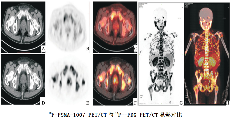 哈医大肿瘤医院开展前列腺癌临床分子成像“狙击”男性高发恶性肿